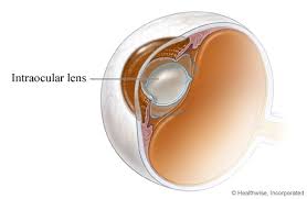 Intraocular Lens